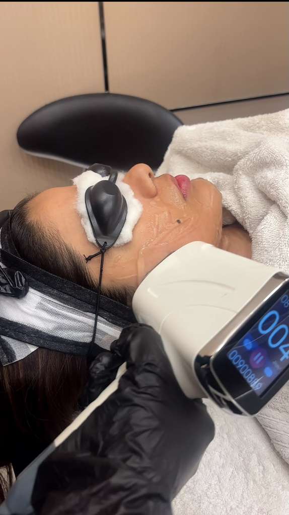 Woman undergoing professional laser facial treatment while wearing protective eye goggles at a skin clinic.
